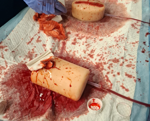 Wundtamponade (Wound Packing) bei einer tiefen Verletzung. Die Wunde wird mit steriler Gaze fest ausgefüllt, um die Blutung von innen zu kontrollieren. Anschließend erfolgt die Sicherung mit einem Druckverband zur weiteren Stabilisierung bis zum Eintreffen des Rettungsdienstes.
