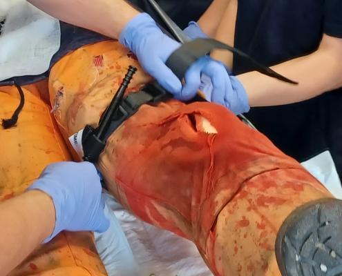 Aufgrund der starken Blutung wird ein Tourniquet oberhalb der Verletzung am Oberschenkel angelegt, um den massiven Blutverlust sofort zu stoppen. Anschließend erfolgt die sterile Wundabdeckung und Anlage einer Israelbandage als zusätzlicher Druckverband. Die Maßnahmen dienen der schnellen Blutstillung und Stabilisierung des Verletzten bis zum Eintreffen des Rettungsdienstes.